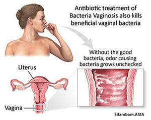 bacterial vaginosis 2