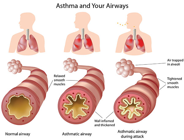 Asthma 2