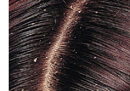 Dandruff 1