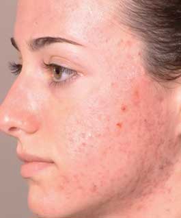 Pimples