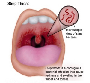 Strep Throat