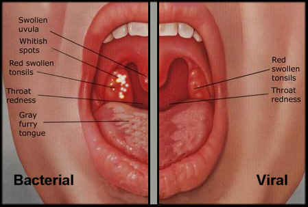 Strep Throat 2